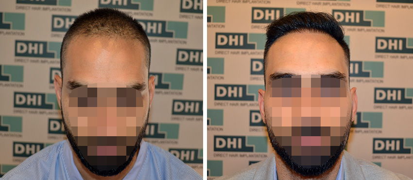 DHI before & after hair transplant results